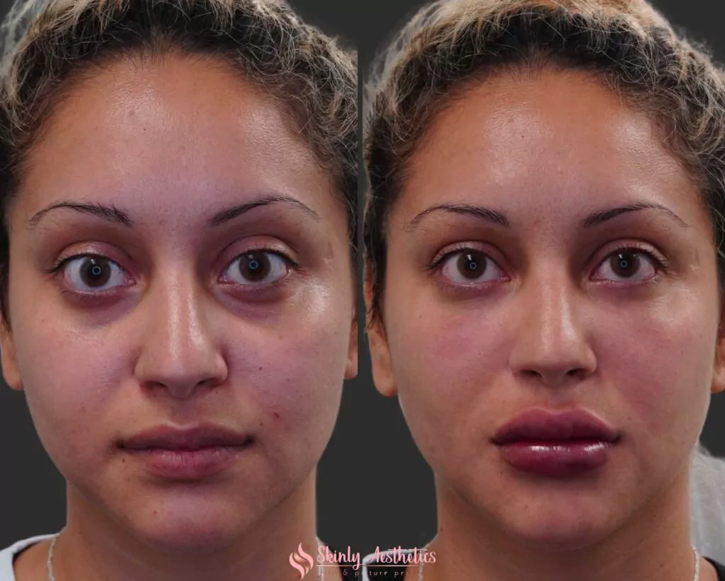 under eye bag treatment with Juvederm filler