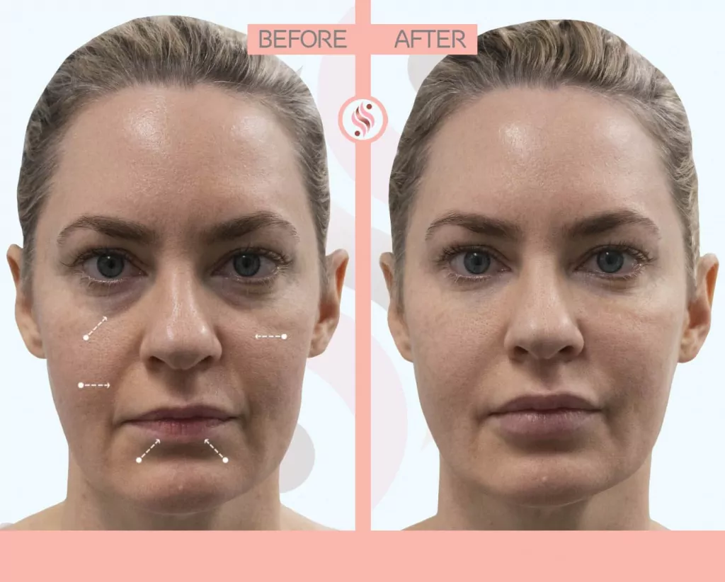 restylane silk before after