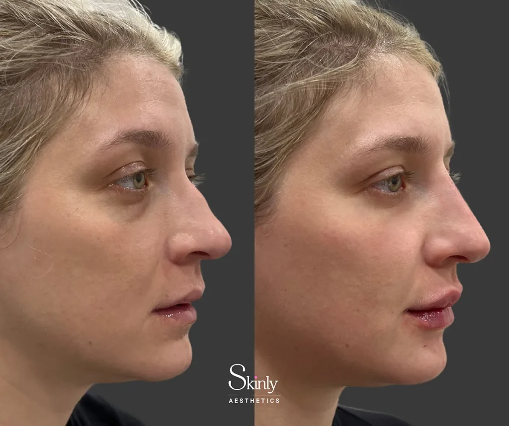 Liquid rhinoplasty before and after correcting dorsal hump and improving nasal contour