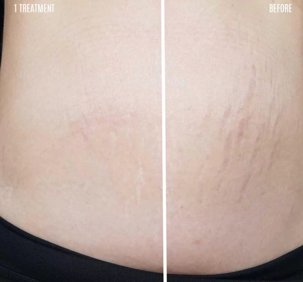 before and after results of stretch marks treated with silicone gel before and after results of stretch marks treated with silicone gel