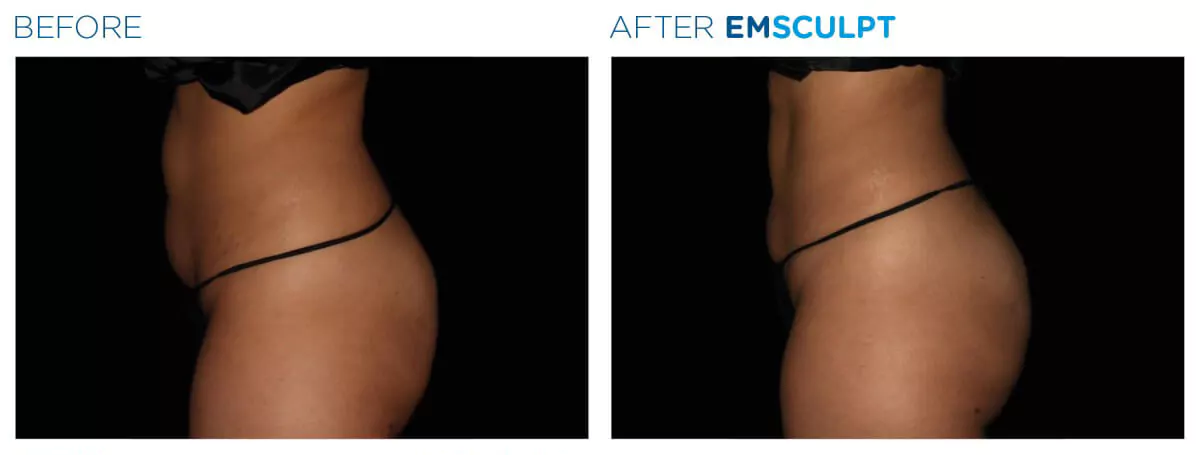 Emsculpt neo before after