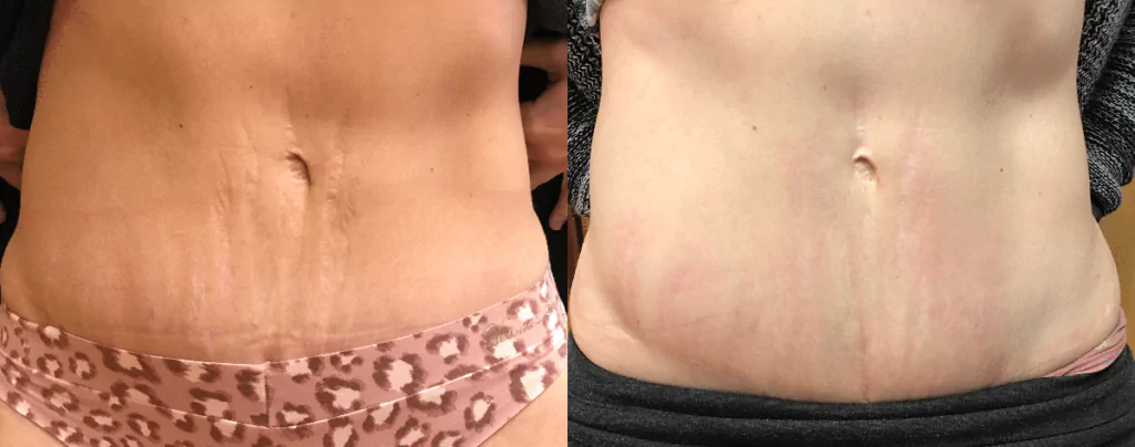 before and after results of treating stretch marks with Ultherapy before and after results of treating abdominal stretch marks with fractional laser technology