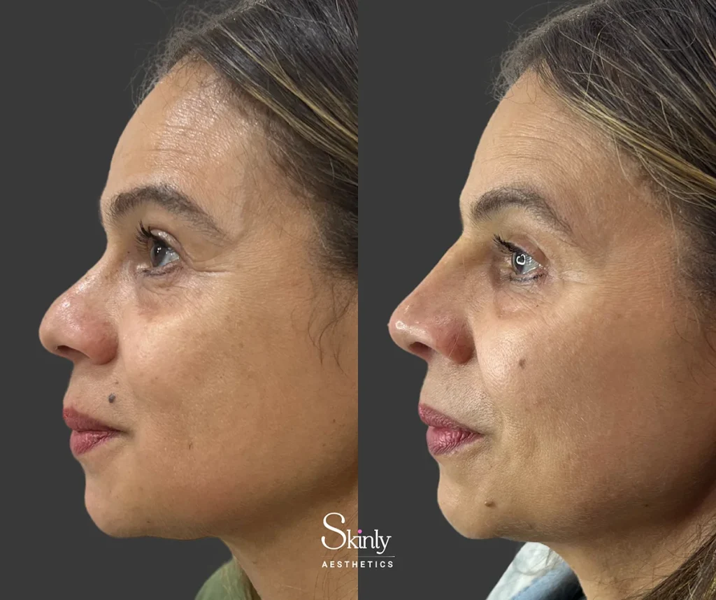 Non-surgical rhinoplasty before and after improving bridge contour and nasal tip