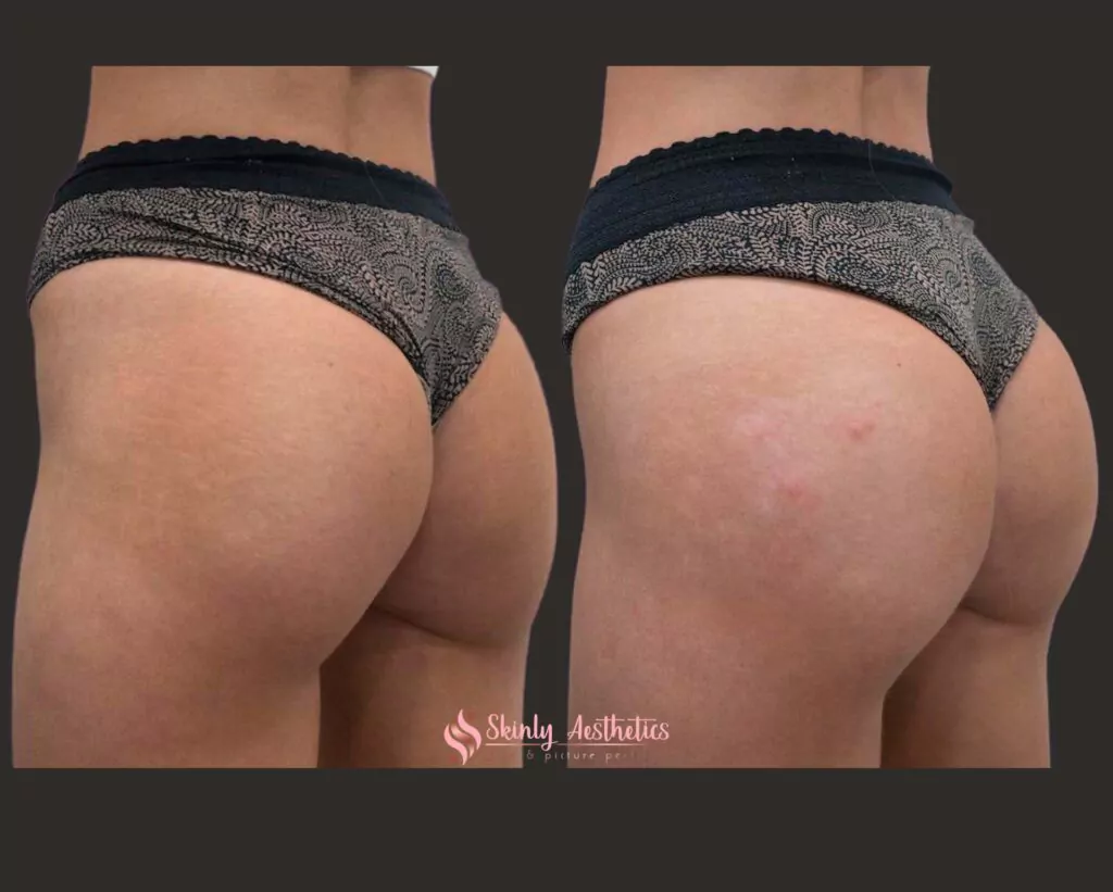 scuptra hips treatment