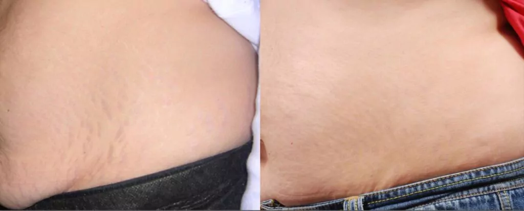 before and after results of stretch marks treated with a chemical peel before and after results of stretch marks treated with a chemical peel