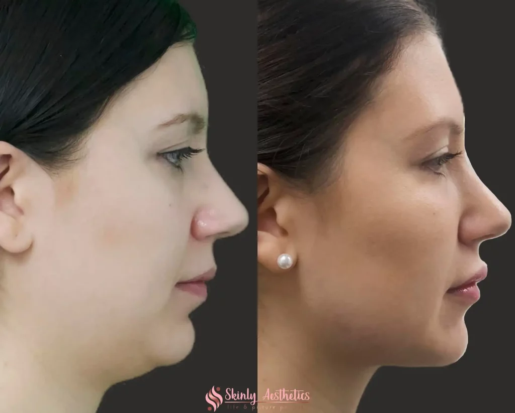 Side profile before and after Kybella treatment demonstrating significant reduction of double chin and improved jawline definition by Dr. Schwarzburg at Skinly Aesthetics in NYC.
