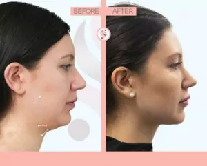 kybella before and after