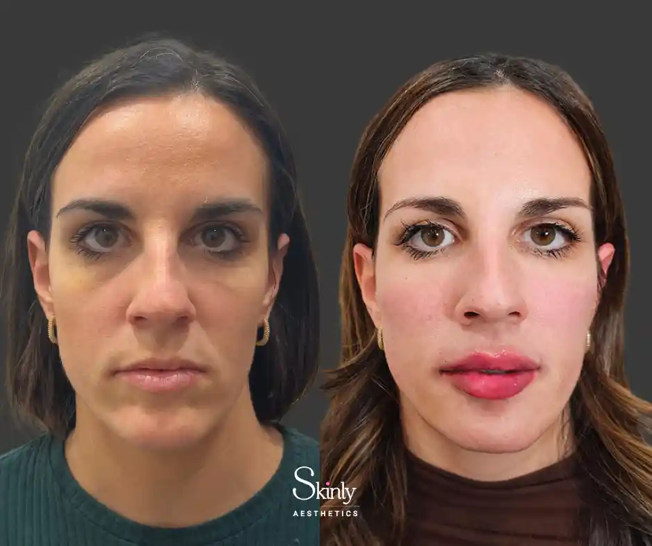 Facial rejuvenation with fillers - NYC liquid facelift before after