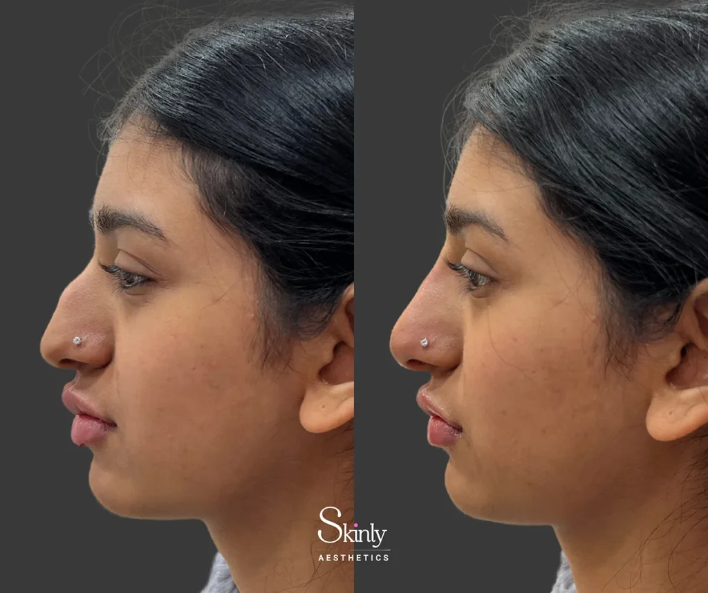 Non-surgical rhinoplasty before and after improving bridge contour and nasal tip