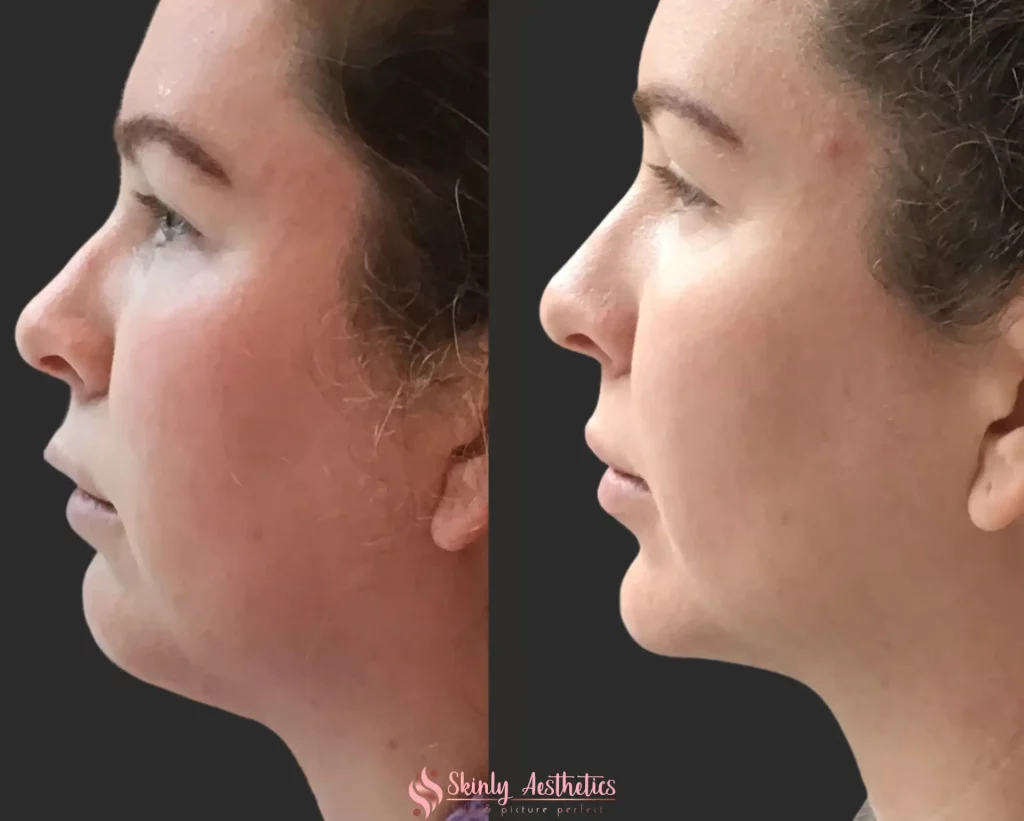 Side profile before and after image demonstrating visible improvement in jawline contour and reduced double chin after Kybella treatment at Skinly Aesthetics. Caption: Post Kybella treatment double chin before and after.